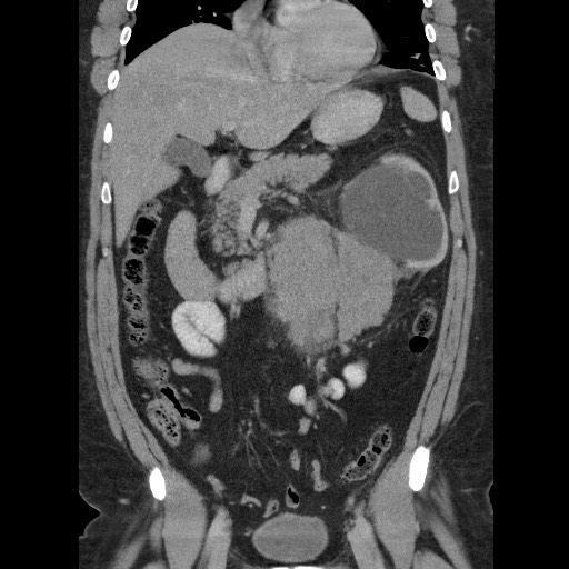 File:Burned-out testicular seminoma - retroperitoneal nodal metastases (Radiopaedia 62872-71245 B 29).jpg