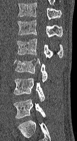 File:Burst fracture (Radiopaedia 53373-59357 Sagittal bone window 26).jpg