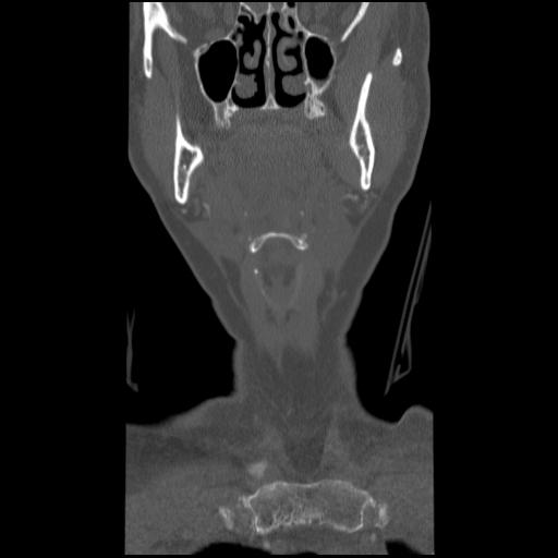 C1 anterior arch (plough) fracture - type 1 (Radiopaedia 76181-87720 Coronal bone window 88).jpg