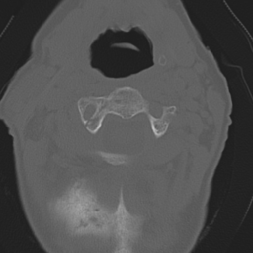 File:C2 fracture with vertebral artery dissection (Radiopaedia 37378-39199 Axial bone window 18).png