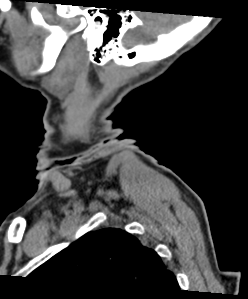 C2 fracture with vertebral artery dissection (Radiopaedia 37378-39199 D 74).png