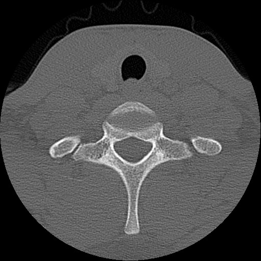 File:C5 facet fracture (Radiopaedia 58374-65499 Axial bone window 78).jpg