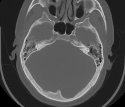 C7 laminar fracture and Klippel-Feil syndrome (Radiopaedia 86710-102850 Axial bone window 9).jpg