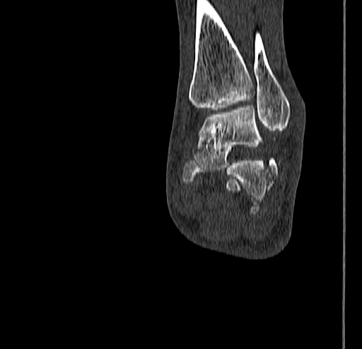 Calcaneal fracture - Sanders type 4 (Radiopaedia 90179-107370 Coronal bone window 62).jpg