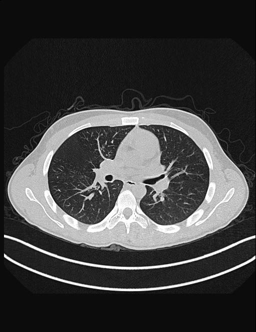 Calcifying pulmonary metastases (Radiopaedia 33359-34396 Axial lung window 29).jpg