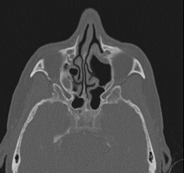 Caldwell-Luc operation (Radiopaedia 52329-58225 Axial bone window 29).jpg