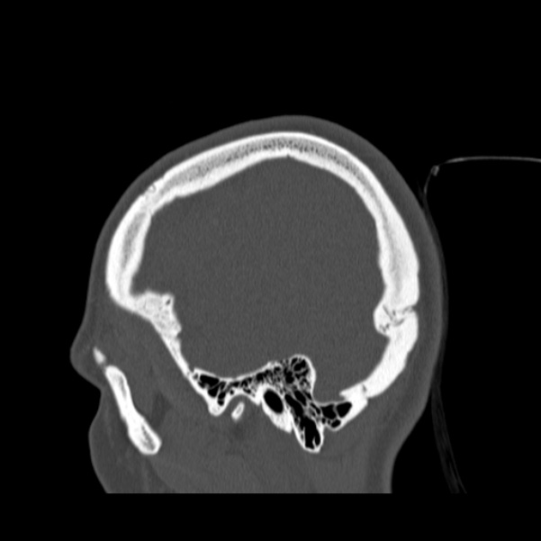 Calvarial osteoma (Radiopaedia 36520-38079 Sagittal bone window 20).jpg