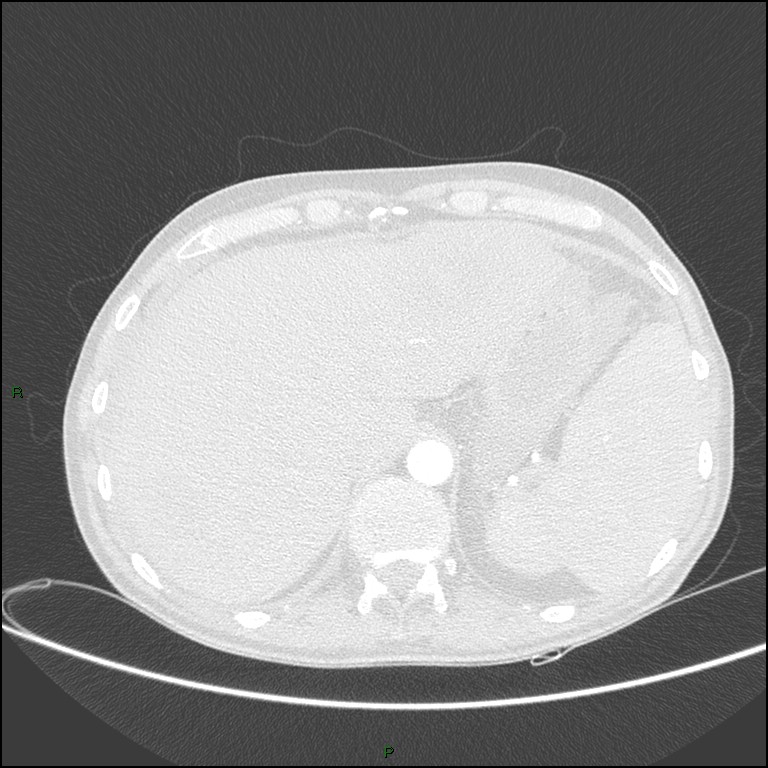 Cannonball metastases (Radiopaedia 82110-96150 Axial lung window 179).jpg