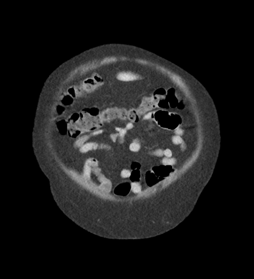 Cannonball metastases from endometrial cancer (Radiopaedia 42003-45031 F 11).png