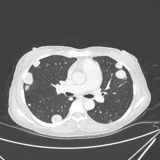 Canonball lung metastasis (Radiopaedia 77634-89837 Axial lung window 81).jpg