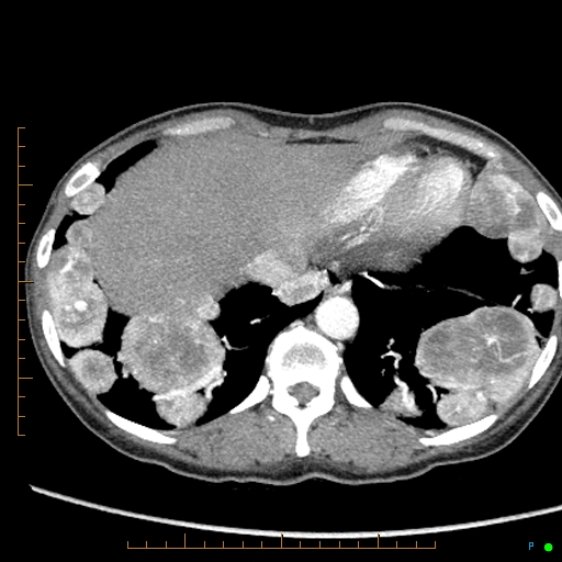 Canonball lung metastasis (Radiopaedia 77634-89837 B 83).jpg