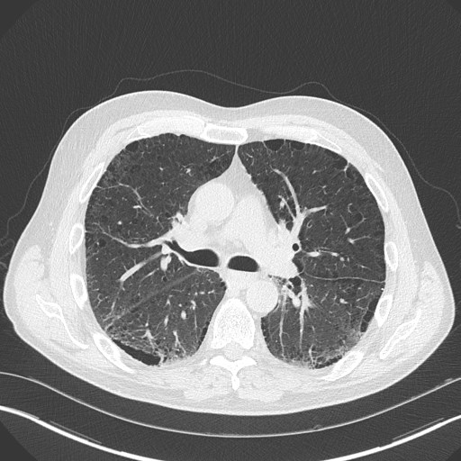 Caplan syndrome (Radiopaedia 56667-63530 Axial lung window 91).jpg