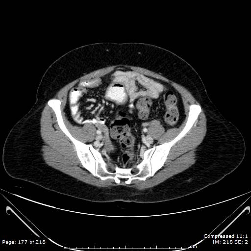 Carcinoid syndrome (Radiopaedia 52706-58626 A 89).jpg