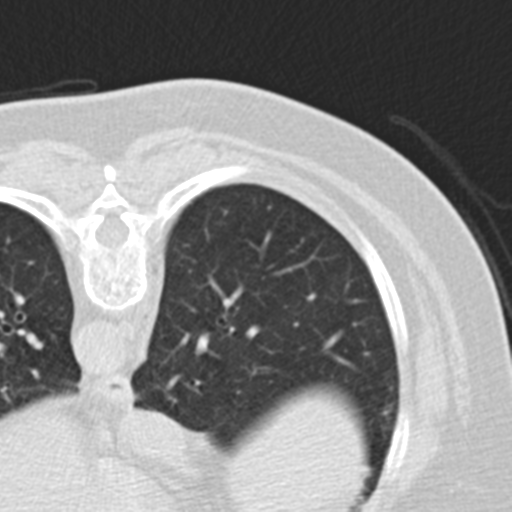Carcinoid tumor - lung (Radiopaedia 44814-48644 Axial lung window 62).png