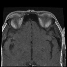 File:Carcinoid tumor of the ileum with metastasis to orbit (Radiopaedia 28165-28424 Axial T1 16).jpg