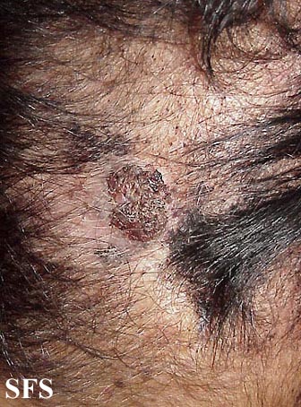 Carcinoma-Verrucous Carcinoma (Dermatology Atlas 1).jpg