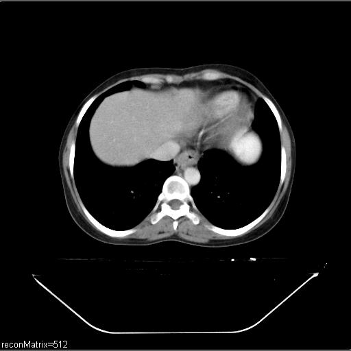 File:Carcinoma of esophagus (Radiopaedia 27356-27550 A 10).jpg