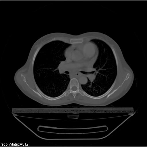 File:Carcinoma of esophagus (Radiopaedia 27356-27550 Axial bone window 19).jpg