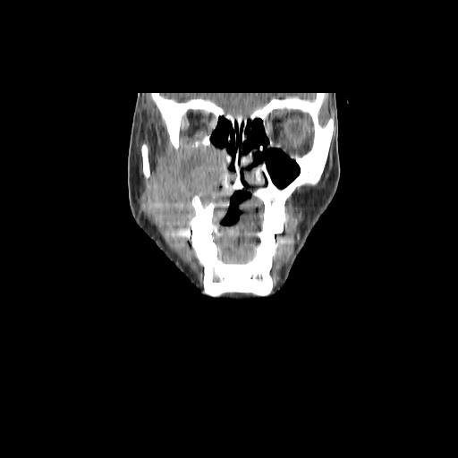 Carcinoma of the maxillary antrum (Radiopaedia 53805-59888 Coronal C+ delayed 35).jpg
