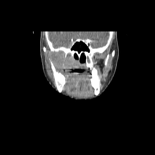 Carcinoma of the maxillary antrum (Radiopaedia 53805-59888 Coronal C+ delayed 61).jpg