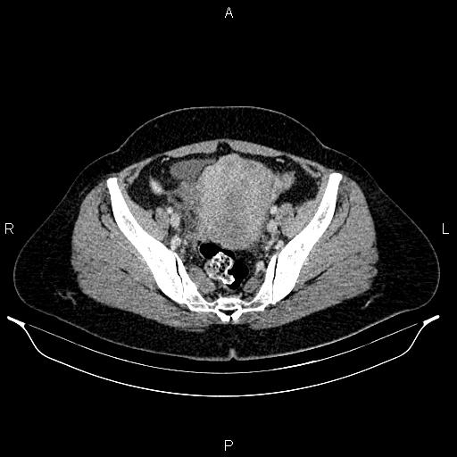 Carcinoma of uterine cervix (Radiopaedia 85861-101700 A 66).jpg