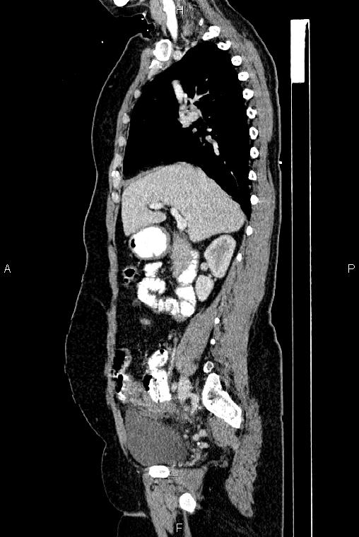 Carcinoma of uterine cervix (Radiopaedia 85861-101700 D 29).jpg