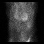 Cardiac amyloidosis (Radiopaedia 51404-57239 A 29).jpg