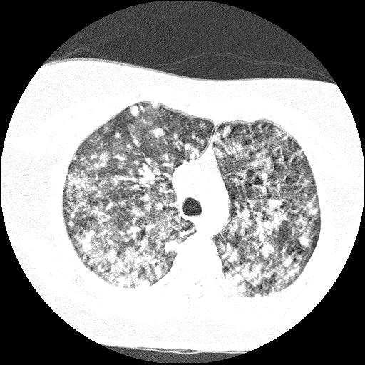 File:Cardiac angiosarcoma (Radiopaedia 66010-75181 Axial lung window 65).jpg