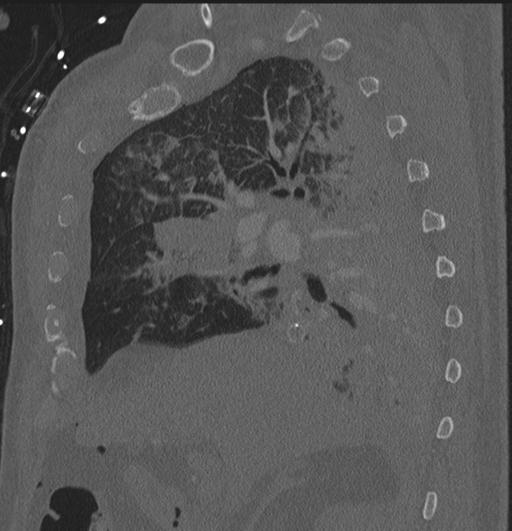 Cardiac trauma (Radiopaedia 32874-33858 Sagittal bone window 73).jpg