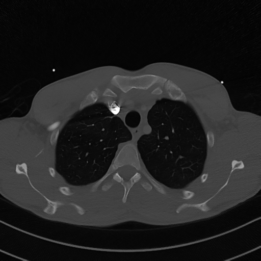 File:Cardiac tumor - undifferentiated pleomorphic sarcoma (Radiopaedia 45844-50134 Axial bone window 15).png