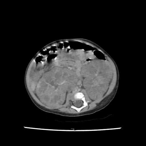 File:Caroli disease with autosomal recessive polycystic kidney disease (ARPKD) (Radiopaedia 89651-106703 B 133).jpg