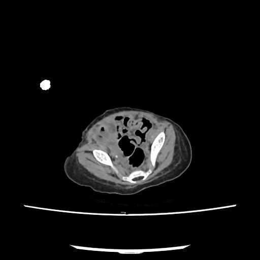 Caroli disease with autosomal recessive polycystic kidney disease (ARPKD) (Radiopaedia 89651-106703 E 203).jpg