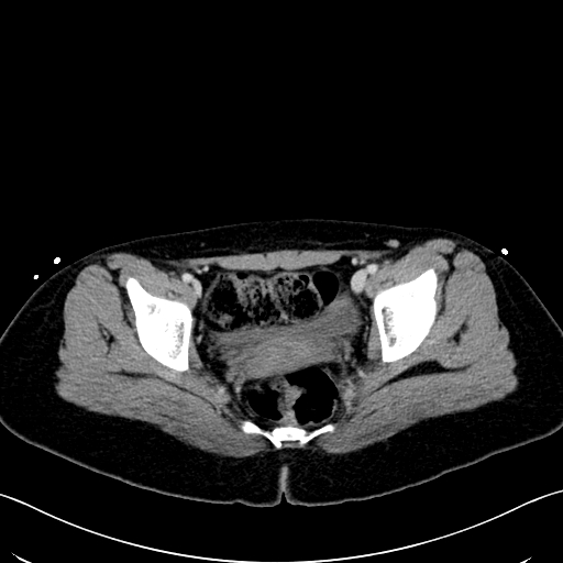 Caroli disease with medullary sponge kidney (Radiopaedia 82622-96804 C 69).jpg