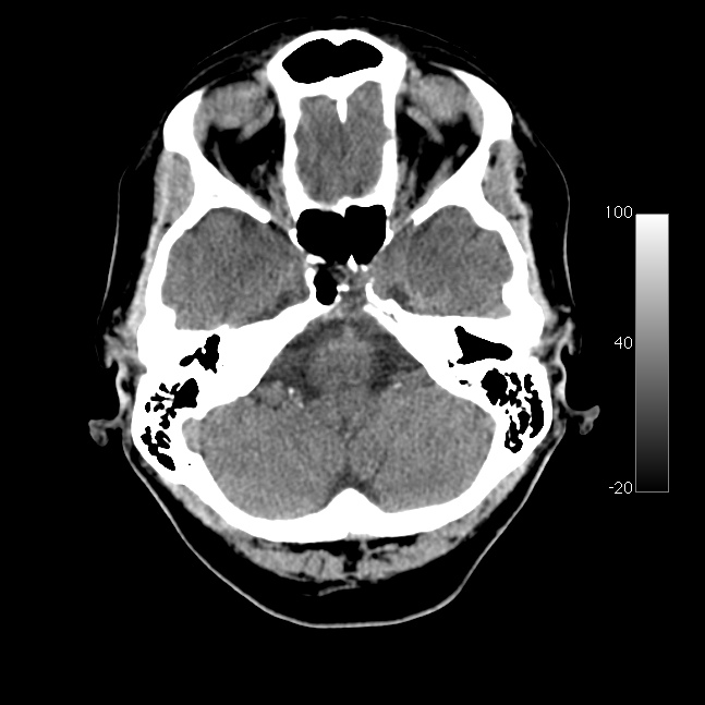 Caroticocavernous fistula (Radiopaedia 14617-14542 Axial non-contrast 6).jpg