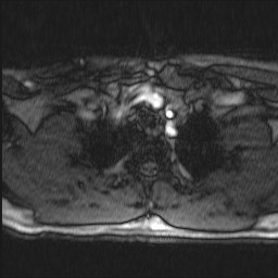 Carotid artery dissection (Radiopaedia 28441-28689 Axial MRA 4).jpg