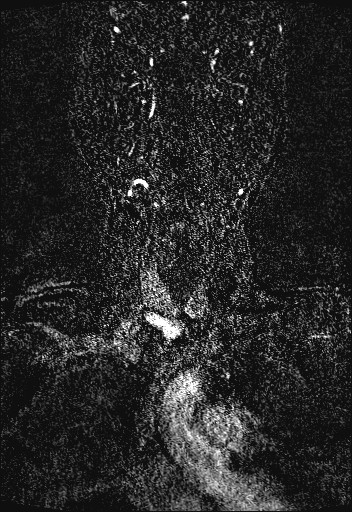 Carotid artery dissection (Radiopaedia 28441-28689 Coronal MRA 12).jpg