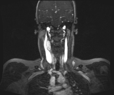 Carotid body tumor (Radiopaedia 12777-12912 MRA 39).jpg