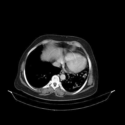 File:Carotid body tumor (Radiopaedia 21021-20948 B 51).jpg