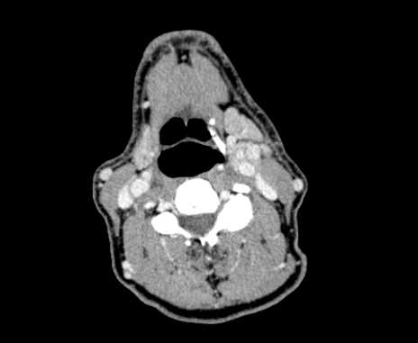 Carotid body tumor (Radiopaedia 61750-69757 Axial Post contrast 55).jpg
