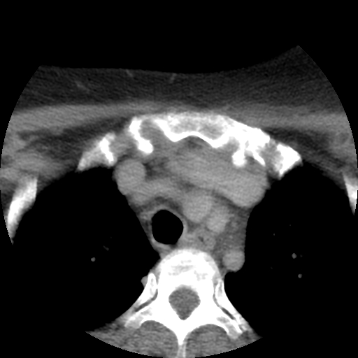 File:Carotid body tumor (paraganglioma) (Radiopaedia 38586-40729 A 69).jpg