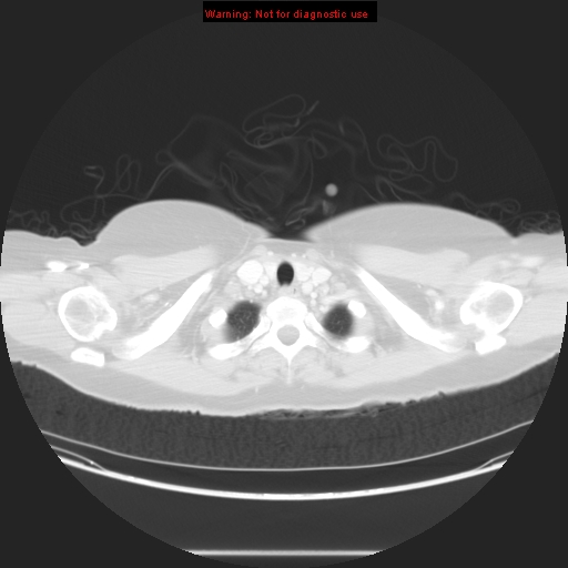 Carotid body tumor with lung metastases (Radiopaedia 9301-48390 Axial lung window 11).jpg