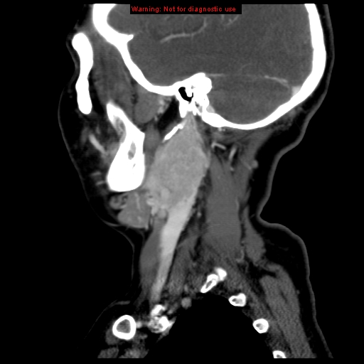 Carotid body tumor with lung metastases (Radiopaedia 9301-9986 Sagittal C+ delayed 40).jpg