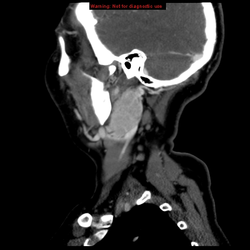 Carotid body tumor with lung metastases (Radiopaedia 9301-9986 Sagittal C+ delayed 43).jpg
