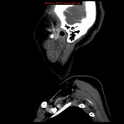 Carotid body tumor with lung metastases (Radiopaedia 9301-9986 Sagittal C+ delayed 49).jpg