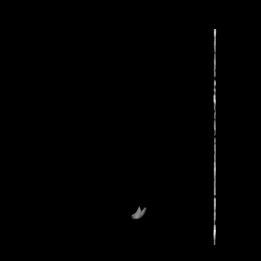 File:Carotid near-occlusion (Radiopaedia 85304-100887 B 3).jpg