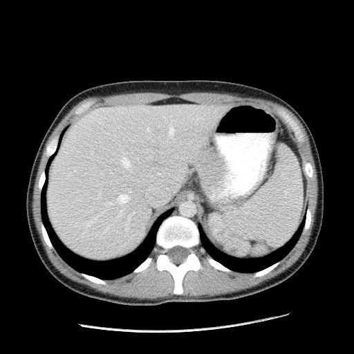 File:Castleman disease with fibrous pseudotumor in the abdomen (Radiopaedia 77296-89373 Axial 93).jpg