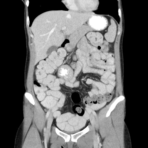 Castleman disease with fibrous pseudotumor in the abdomen (Radiopaedia 77296-89373 B 33).jpg