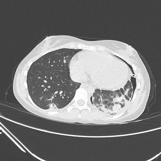 File:Catamenial pneumothorax (Radiopaedia 27946-28197 lung window 114).jpg