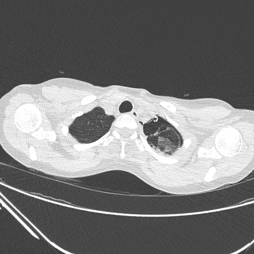 Catamenial pneumothorax (Radiopaedia 27946-28197 lung window 27).jpg