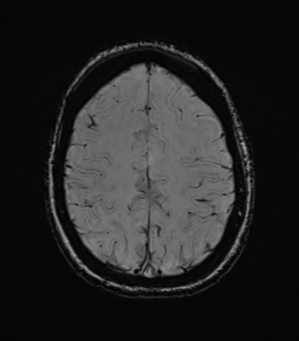 File:Cavernoma with bleed - midbrain (Radiopaedia 54546-60773 Axial SWI 37).png